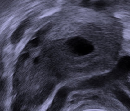 Corpus Luteum (Gelbkörper): Was es ist, was es tut und warum es für die Fruchtbarkeit wichtig ist